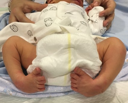 pie-equino-varo-uca-infantil