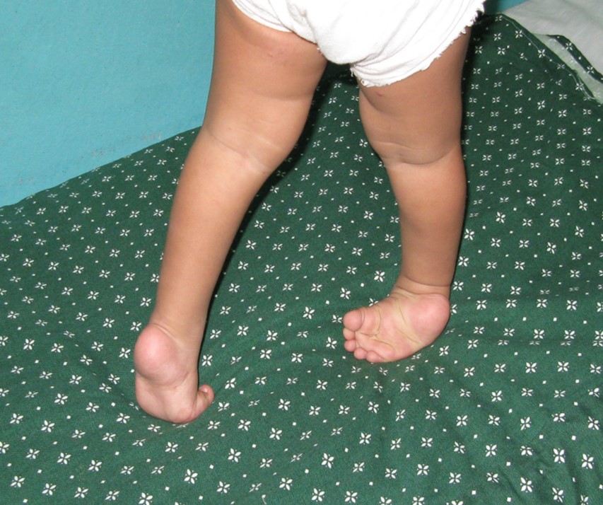 pie-equino-varo-uca-infantil-marcha