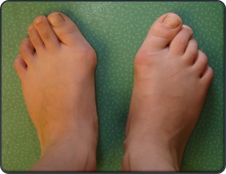 hallux-valgus-uca-infantil