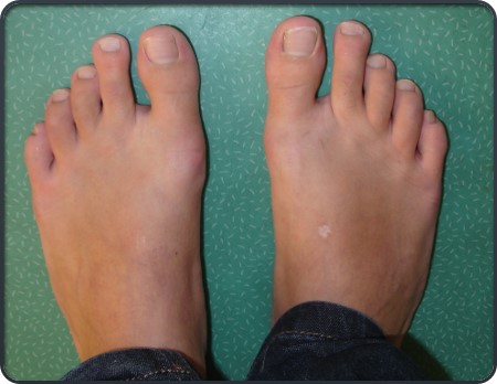 hallux-valgus-cirugia-percutanea-uca- infantil